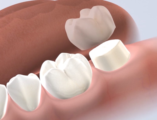 Dental Crowns