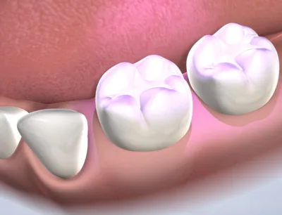 Dental Sealants
