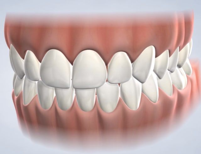 Icon® Dental Treatment