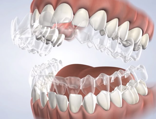Invisalign®