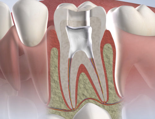 Root Canal Treatment